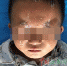 南昌3岁男童玩502胶水被糊眼（图） - 中国江西网